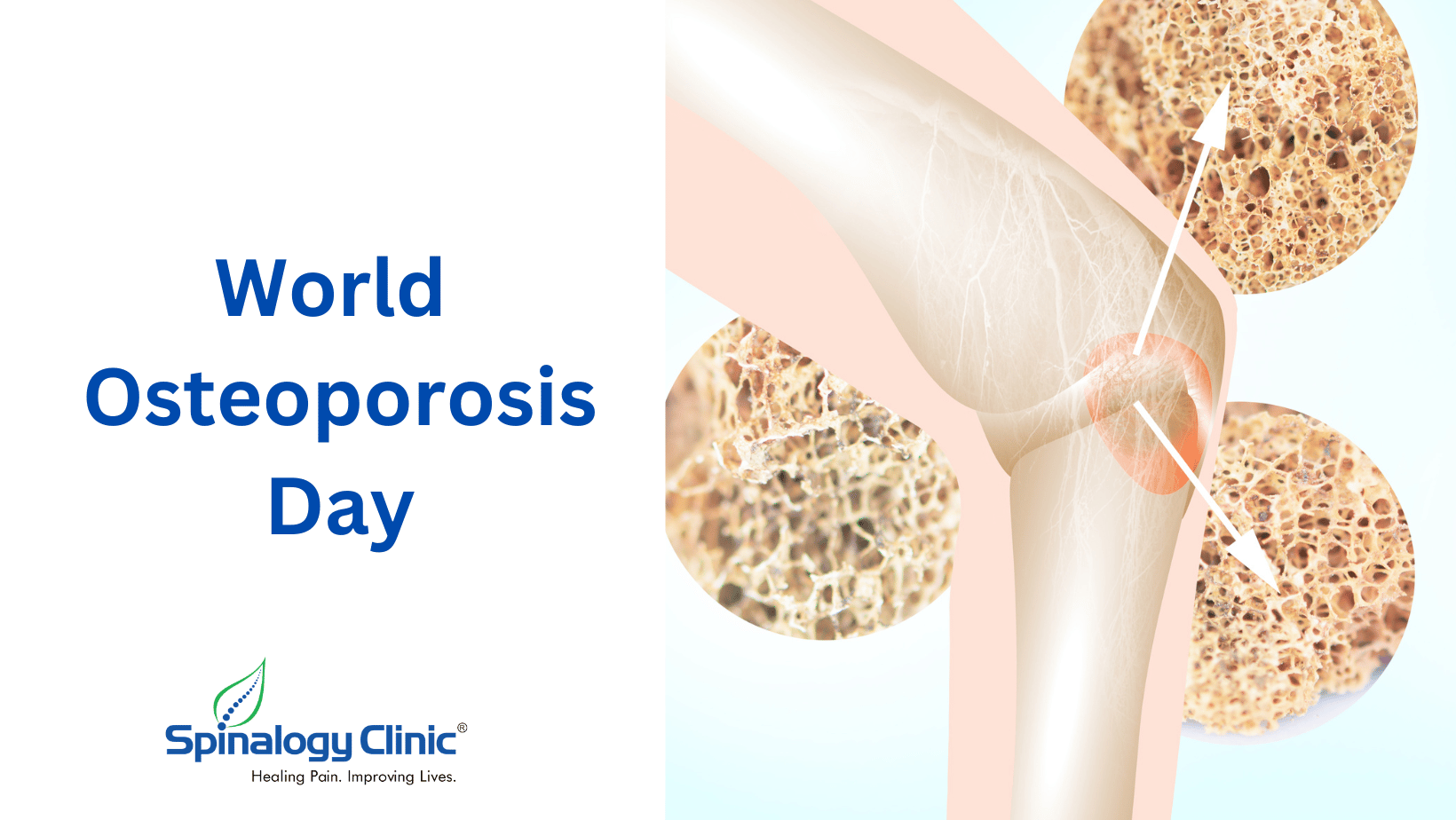 World Osteoporosis Day